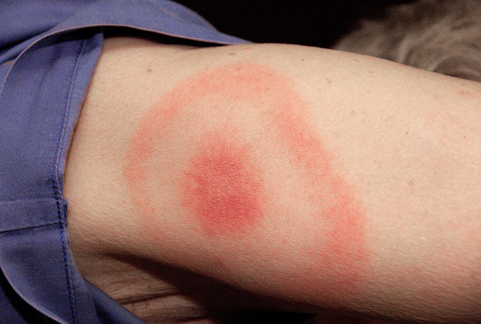 Lyme-Borreliose Ausschlag Bulls Eye Spot Zeckenbiss